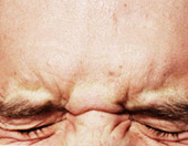 man suffering from eye strain